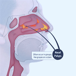 Nasal Polyps, Deep Treating with NasoNeb – NasoNeb®